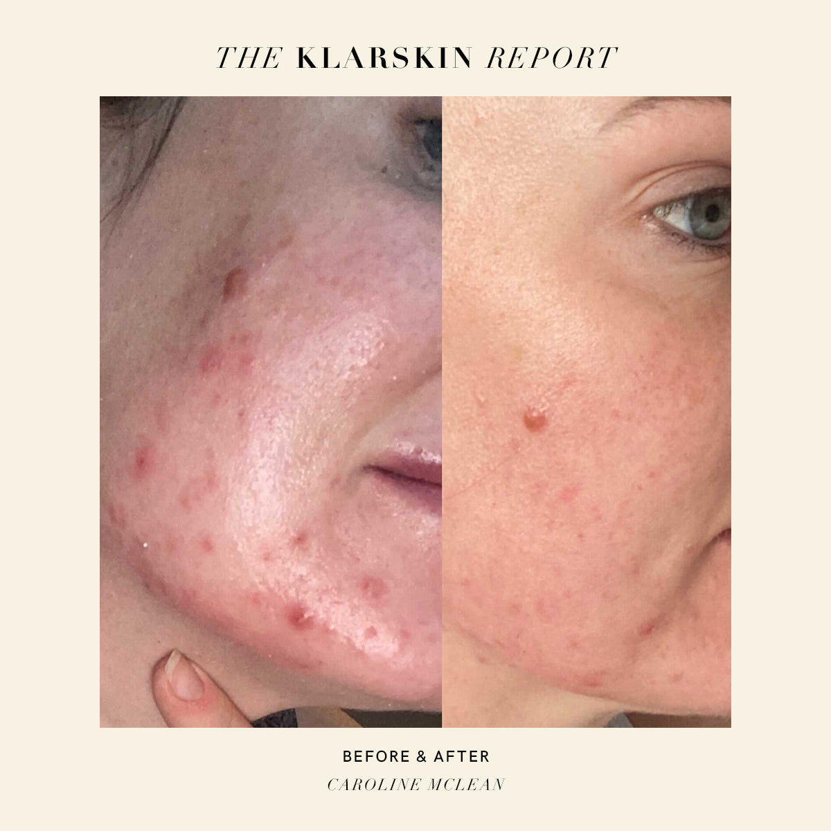 BEST CLEAR SKIN TREATMENT