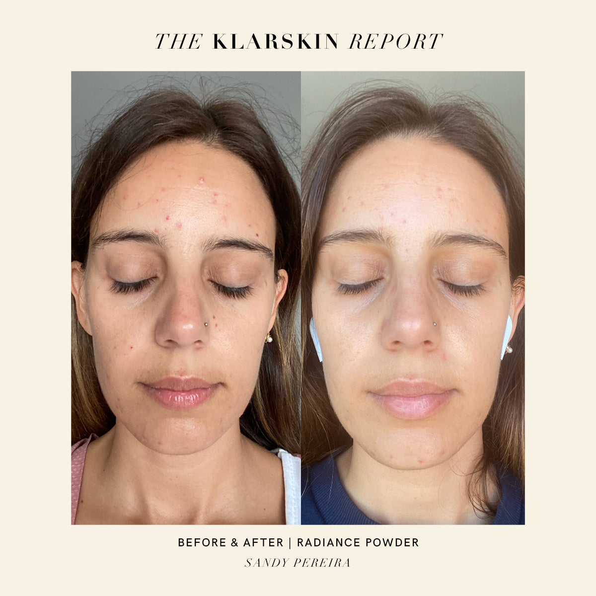 SANDY PEREIRA'S ADULT ACNE STORY